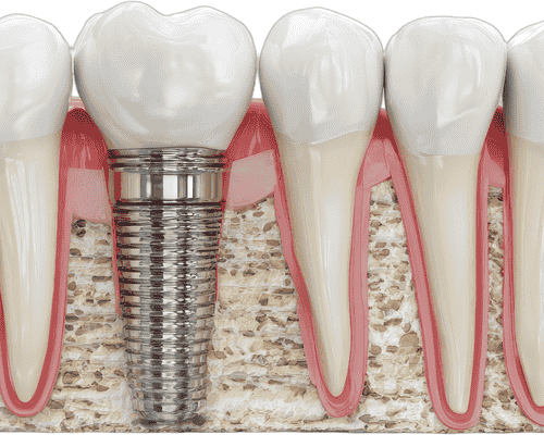 Dental Implants