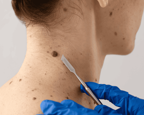 Mole Removal